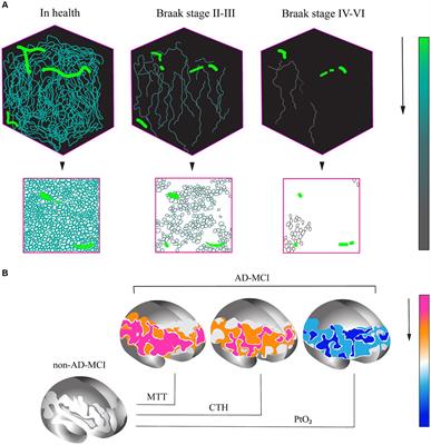 Development of capillary dysfunction in Alzheimer’s disease